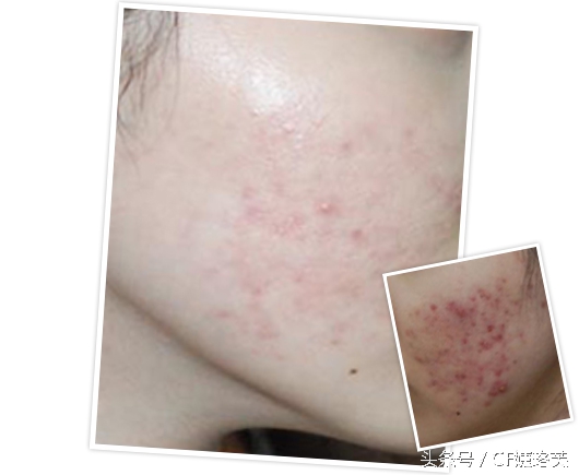 痘痘的生长过程视频,痘痘的发展过程素材