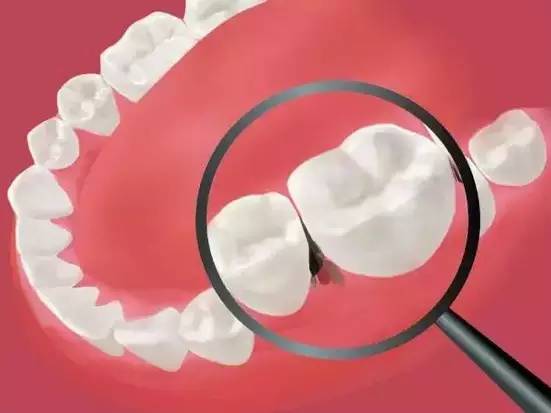 一吃东西就塞牙有什么好办法,怎样防止食物塞牙