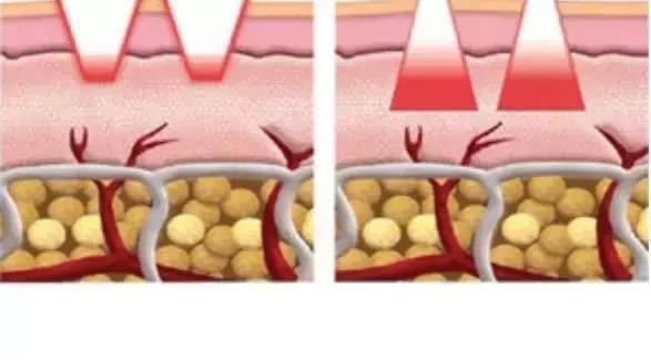 背上痘痘留下的痘印怎么消除,痘痘没了之后的印子怎么处理