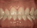 龅牙虎牙矫正的全过程,前牙凸矫正牙齿的全部过程