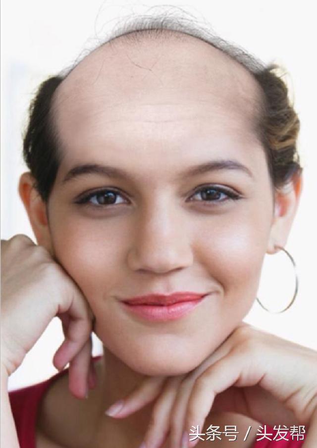 秃顶是什么遗传方式,秃顶是什么原因造成的女生