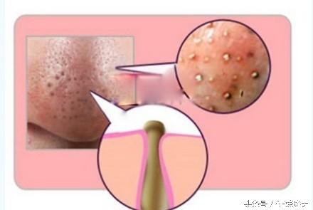 痘痘的生长过程视频,痘痘的发展过程素材