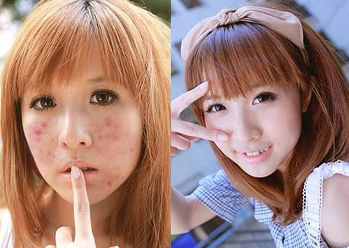 怎么修复痘痘皮肤,痘痘皮肤怎么调理