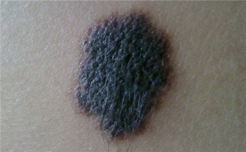 孙红雷曾说:得了黑痣赶紧点,千万别以为是好运和性感!真的吗?