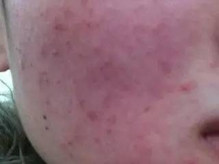 激素依赖性皮炎用什么牌子护肤品 (轻度激素依赖性皮炎用什么护肤品)