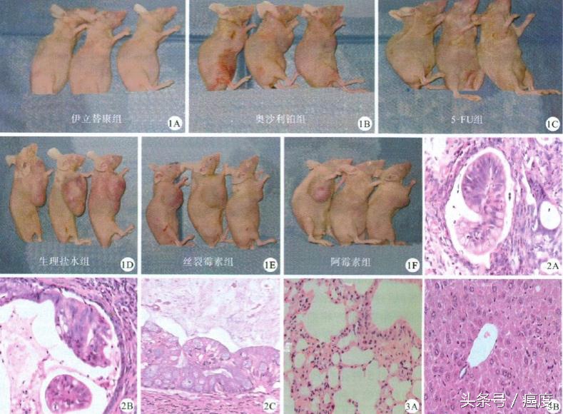 体外化疗,肿瘤化疗药物敏感性试验