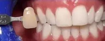 关于牙齿你需要知道的三件事,关于美白那些你不得不知道的事儿