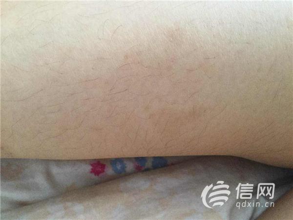 激光脱毛色素沉淀,激光脱毛部位有痣