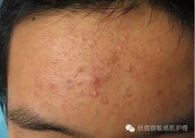 痘痘的形成和原因大全,痘痘的形成的原因分析