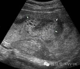 孕期出血有哪些危险,孕期阴道出血的症状