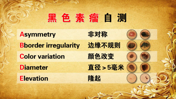 孙红雷曾说:得了黑痣赶紧点,千万别以为是好运和性感!真的吗?
