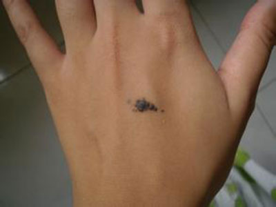 孙红雷曾说:得了黑痣赶紧点,千万别以为是好运和性感!真的吗?