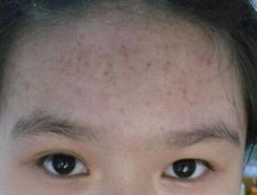 额头全是小米粒的痘痘怎么去掉,额头上有很多痘痘怎么办