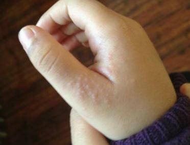 水泡湿疹怎么治疗？老中医妙招治皮肤病湿疹。