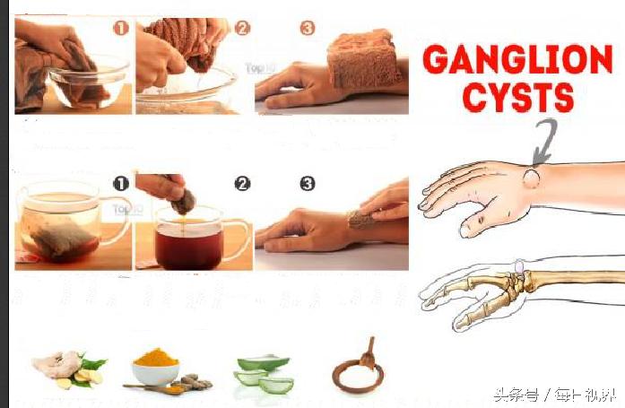 治疗腱鞘囊肿的特效方子真灵验,怎么自己在家捏爆腱鞘囊肿