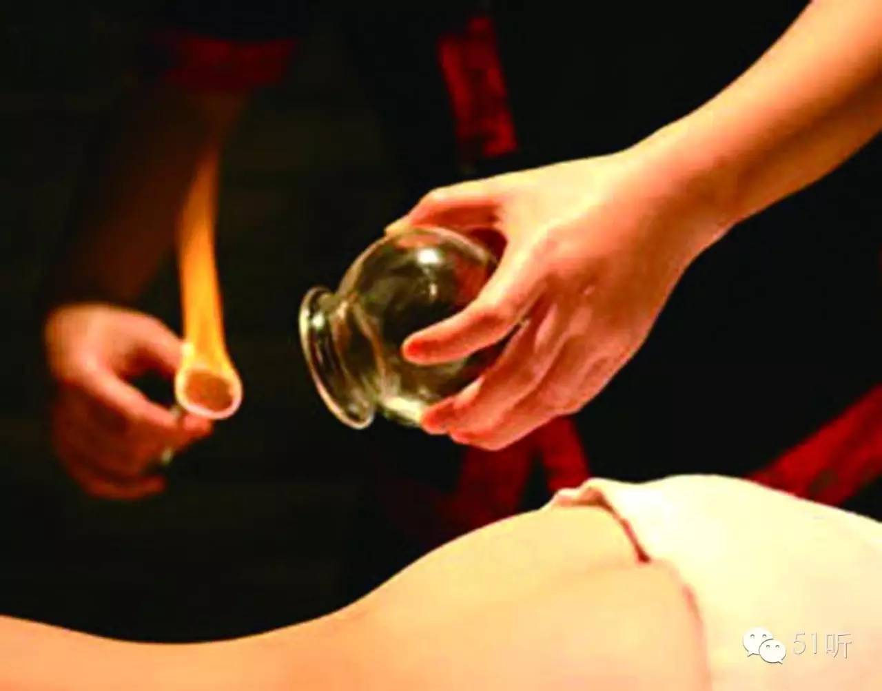 飞鱼拔罐,飞鱼拔火罐