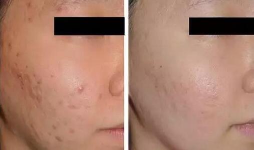 背上痘痘留下的痘印怎么消除,痘痘没了之后的印子怎么处理
