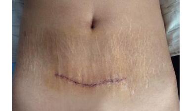 剖腹产伤口疤痕能不能自己消失,剖腹产后疤痕要多久才能恢复