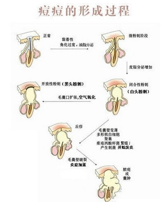 下巴长痘痘的图片和分析,下巴长痘老中医推荐