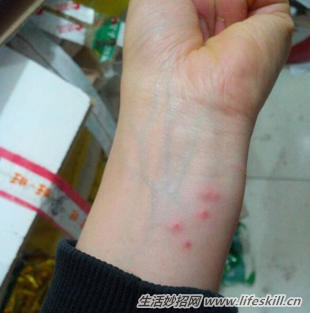被跳蚤咬了如何快速止痒图片,被跳蚤咬了如何快速止痒