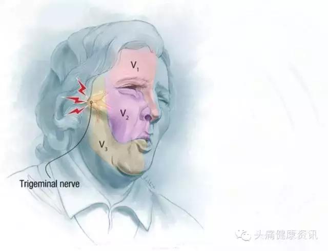 电疗头痛仪,头痛用低频电子治疗仪