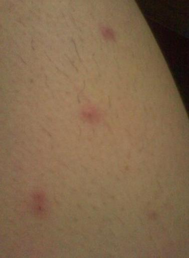 水泡湿疹怎么治疗？老中医妙招治皮肤病湿疹。