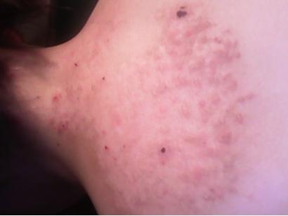 神经性皮炎抹药膏的方法,神经性皮炎用什么中药洗