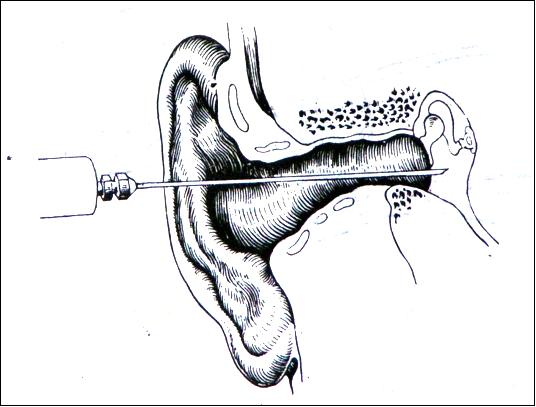 如何治疗分泌性中耳炎,分泌性中耳炎能自愈吗