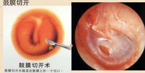 如何治疗分泌性中耳炎,分泌性中耳炎能自愈吗