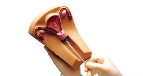 女性上环好还是男性结扎好点,是女性上环好还是男人结扎好