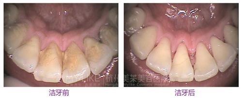 洗牙后牙龈还是出血是怎么回事,牙龈已萎缩经常出血需要洗牙吗