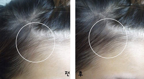发际线高导致颜值直线下降,发际线高低真的会影响颜值吗