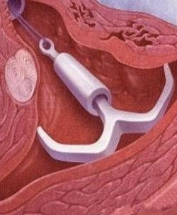 男人,如果你爱你的女人,就别让她上环!