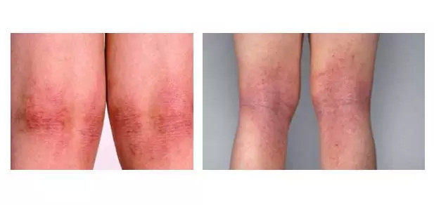 皮肤皮炎湿疹咋治,皮炎湿疹和皮肤过敏的区别