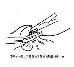 女性结扎恢复的手术过程,女性结扎的手术流程