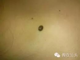 一图读懂什么样的痣易癌变,点痣后增生了肉痣会变癌吗