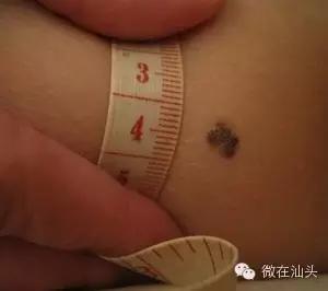 一图读懂什么样的痣易癌变,点痣后增生了肉痣会变癌吗
