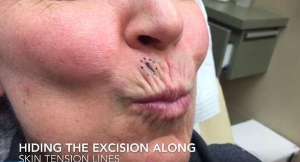 医生从她人中上的不明肿瘤一刀切下去后，这东西竟然蹦出來！慎入