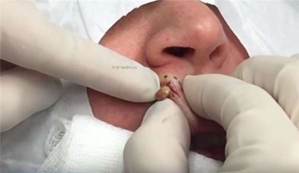 医生从她人中上的不明肿瘤一刀切下去后，这东西竟然蹦出來！慎入