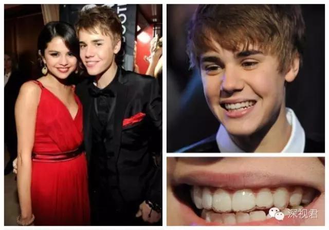 牙齿矫正舌侧牙套经历分享,牙齿矫正隐形牙套真人日记