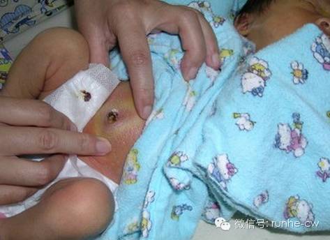 十四天的宝宝脐带还没掉,宝宝脐带结痂什么时候脱落