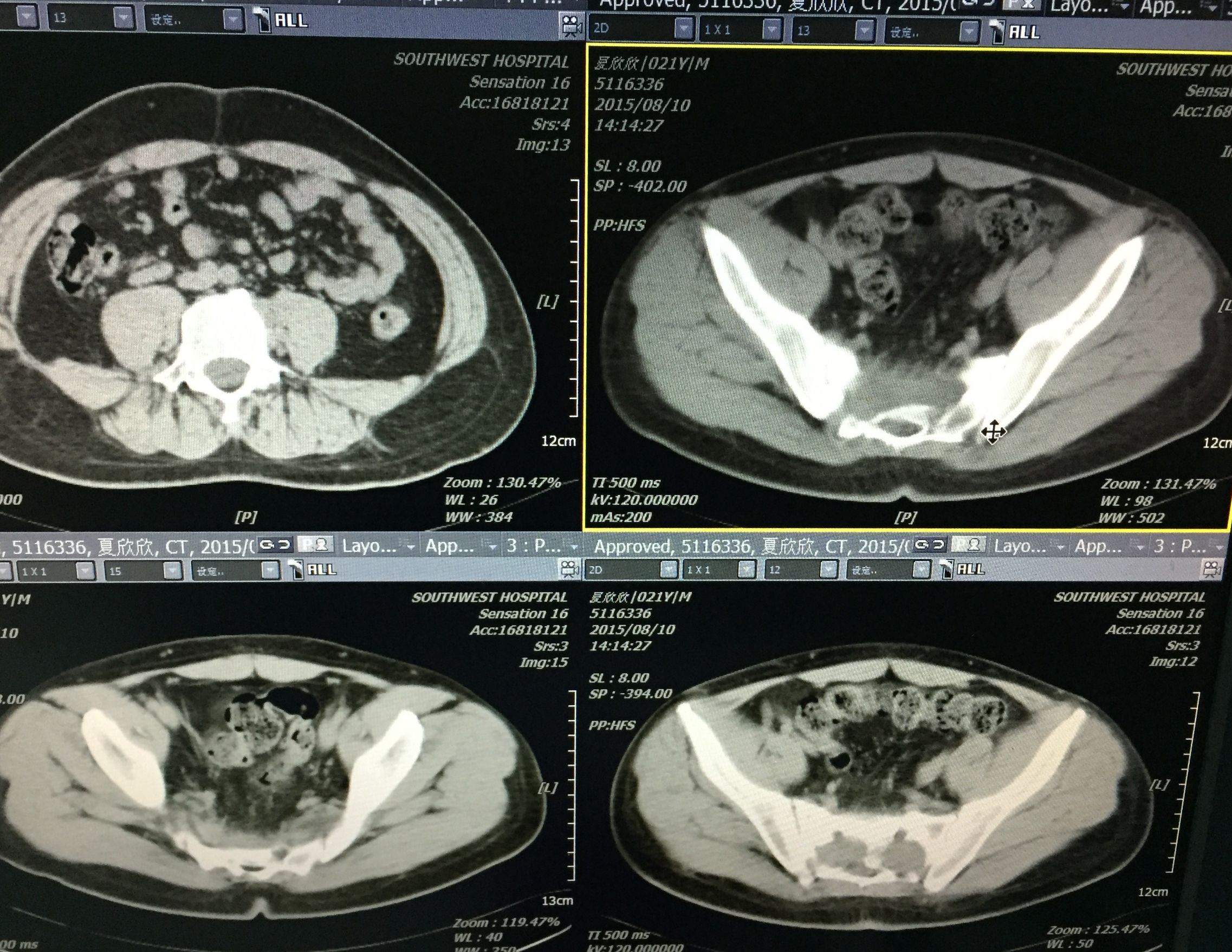 你知道吗？脊柱、盆腔结核脓肿可以穿刺引流联合抗痨治疗。