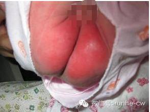 六个月宝宝小鸡皮前面发红肿了,宝宝小鸡皮前面发红发肿怎么办