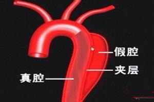 主动脉夹层一般是什么原因造成的,主动脉夹层是什么原因导致的呢