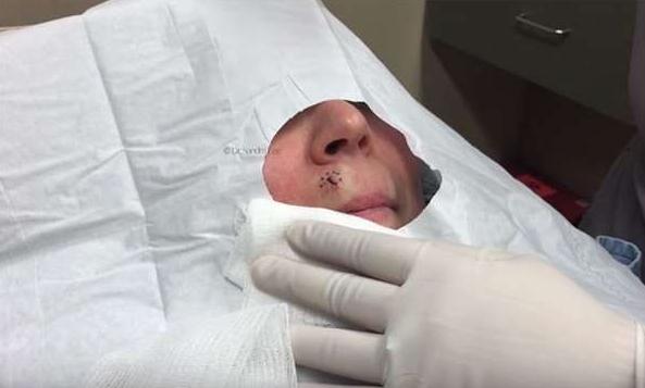 医生从她人中上的不明肿瘤一刀切下去后，这东西竟然蹦出來！慎入