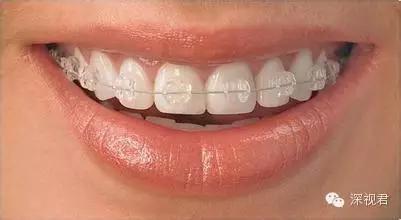 牙齿矫正舌侧牙套经历分享,牙齿矫正隐形牙套真人日记