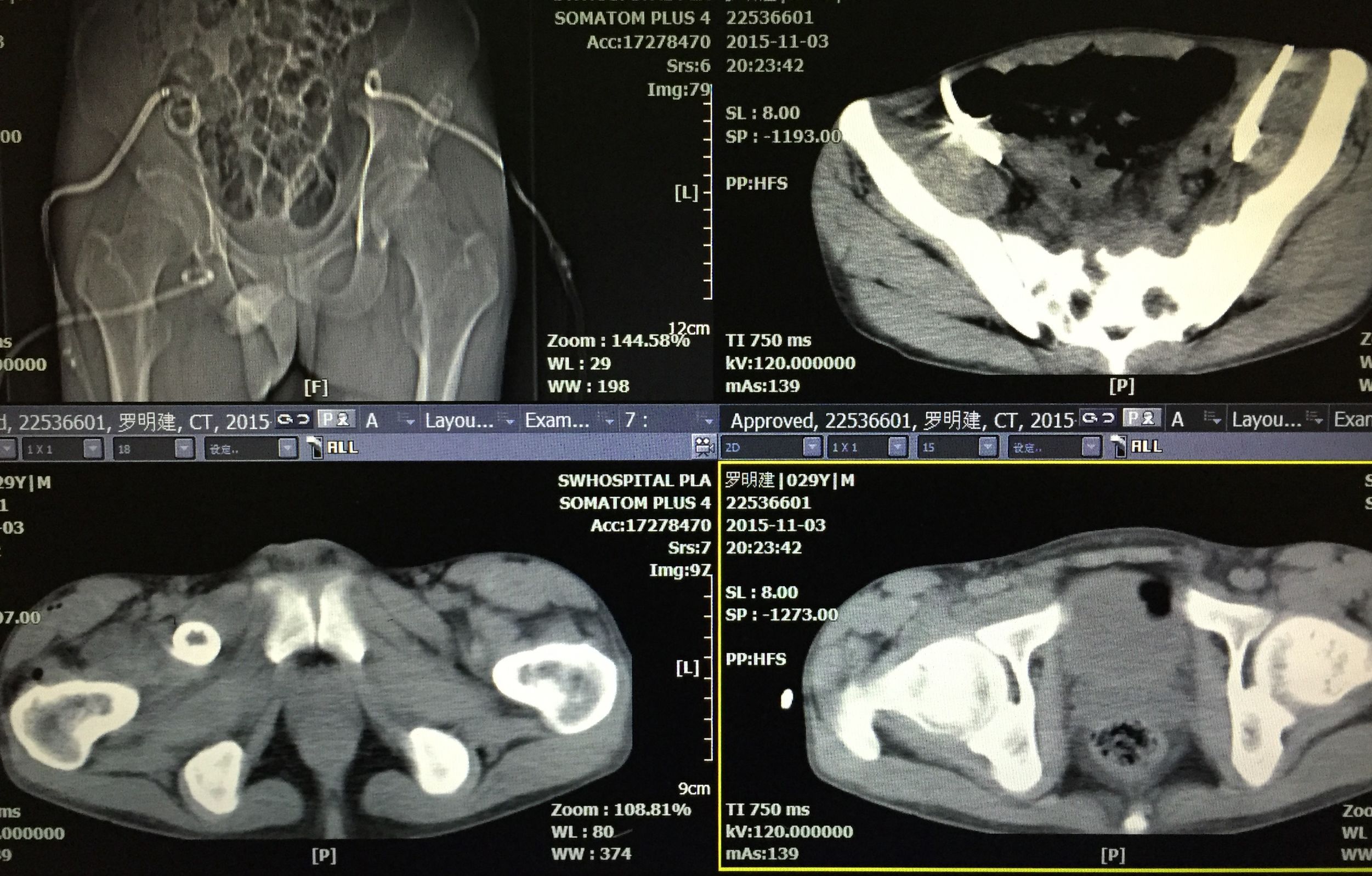 你知道吗？脊柱、盆腔结核脓肿可以穿刺引流联合抗痨治疗。