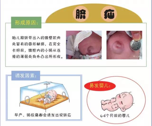 怎么护理宝宝肚脐不让翻出来,小儿肚脐护理