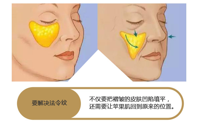 法令纹玻尿酸填充多久能洗脸化妆,法令纹填充玻尿酸会越填越深吗