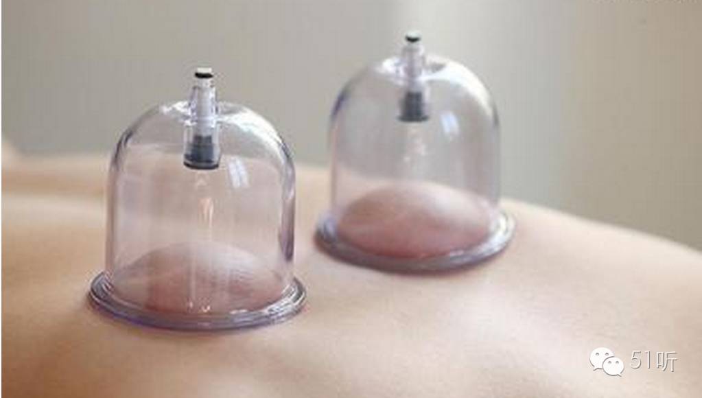 飞鱼拔罐,飞鱼拔火罐